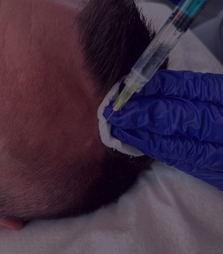 Mezoterapia witaminowa skóry głowy w Perfect Hair Clinic