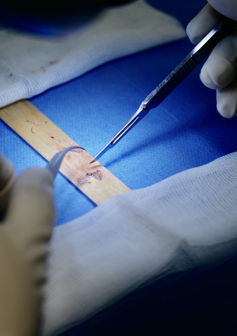 Manualny przeszczep włosów — precyzyjna praca pęsetą