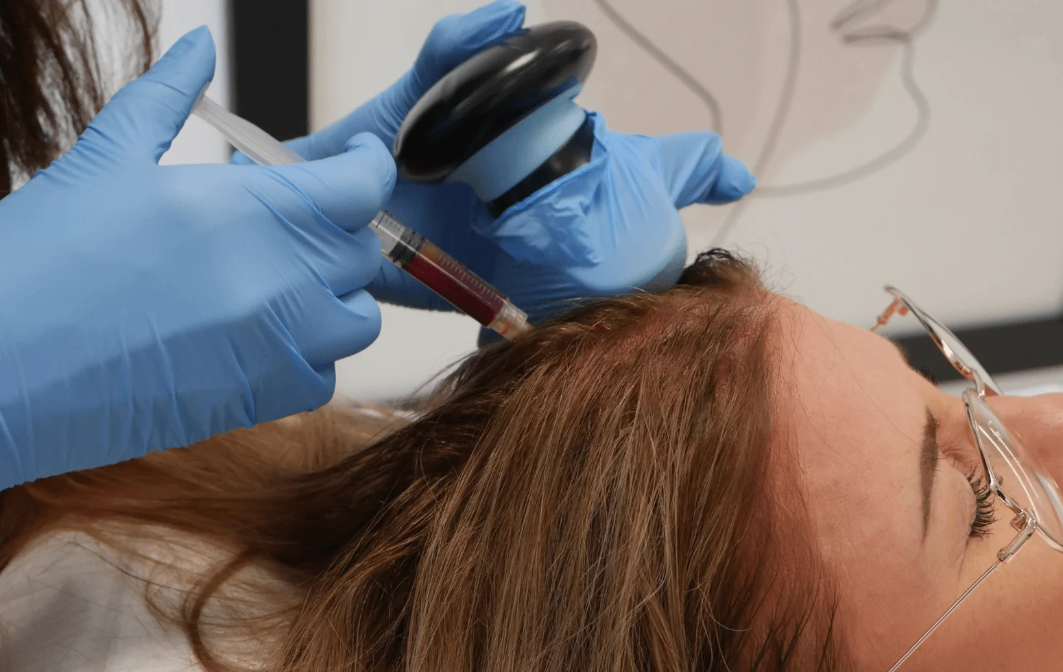 mezoterapia skóry głowy