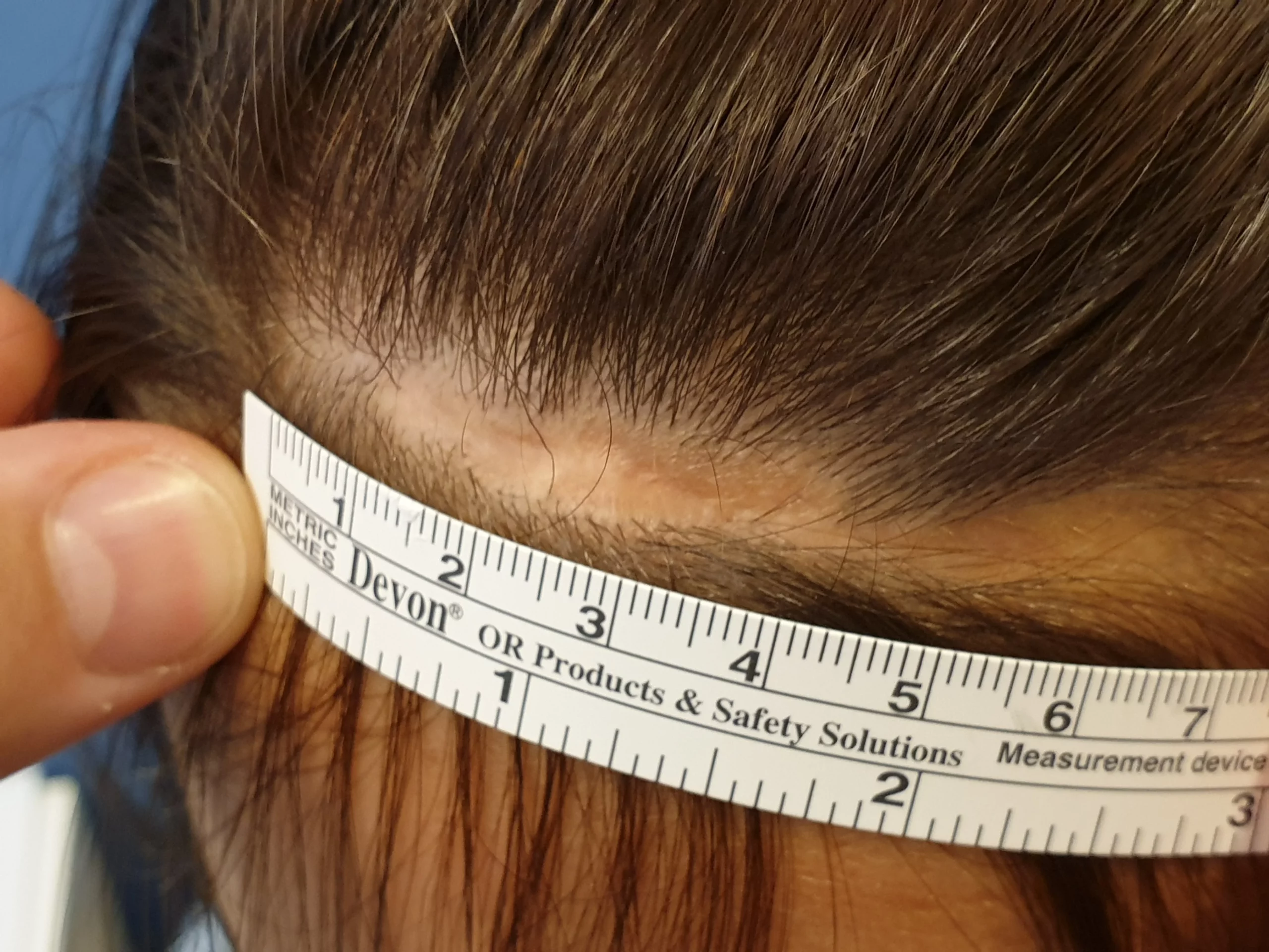 Pomiar linii włosów podczas konsultacji w Perfect Hair Clinic