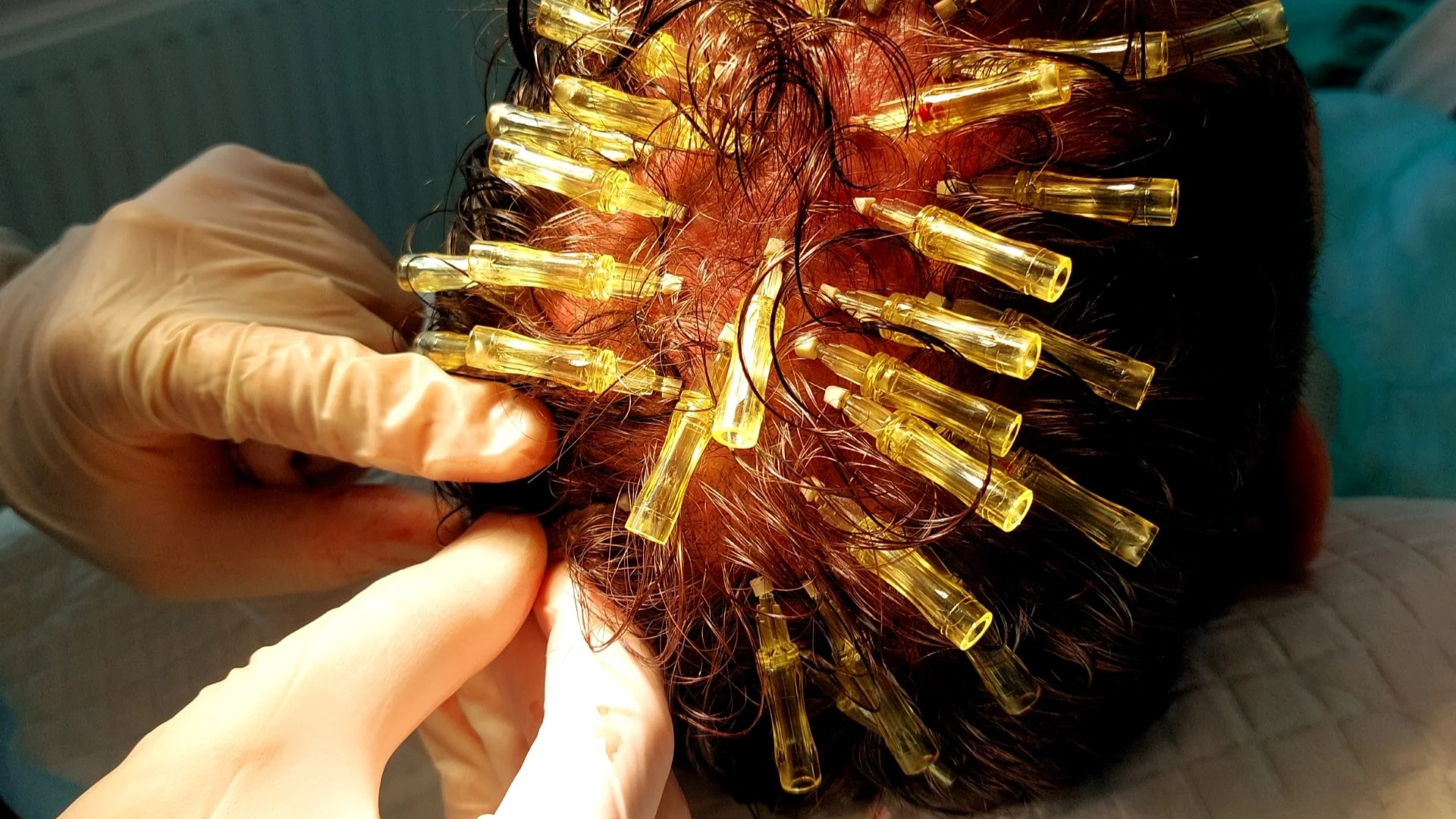 Klinika PHC Katowice metody leczenia łysienia