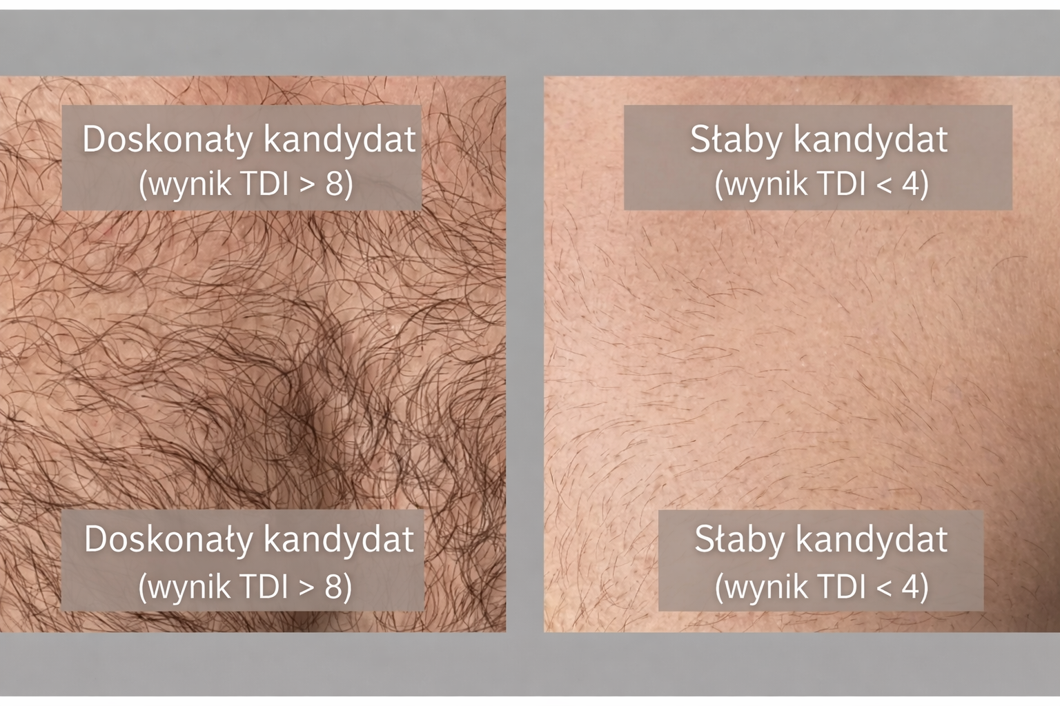 Wskaźnik Dawstwa z Tułowia (TDI) – porównanie doskonałego i słabego kandydata na podstawie gęstości owłosienia na klatce piersiowej