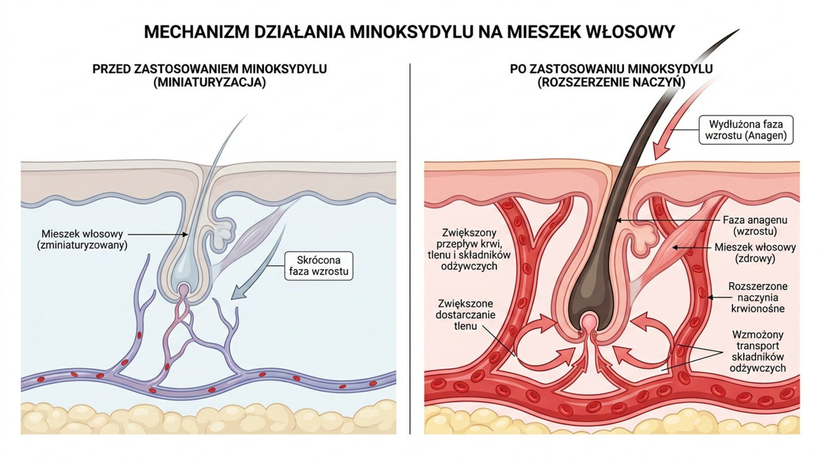 Mechanizm działania minoksydylu na mieszek włosowy — przed zastosowaniem miniaturyzacja i skrócona faza wzrostu, po zastosowaniu rozszerzenie naczyń i wydłużona faza anagenu