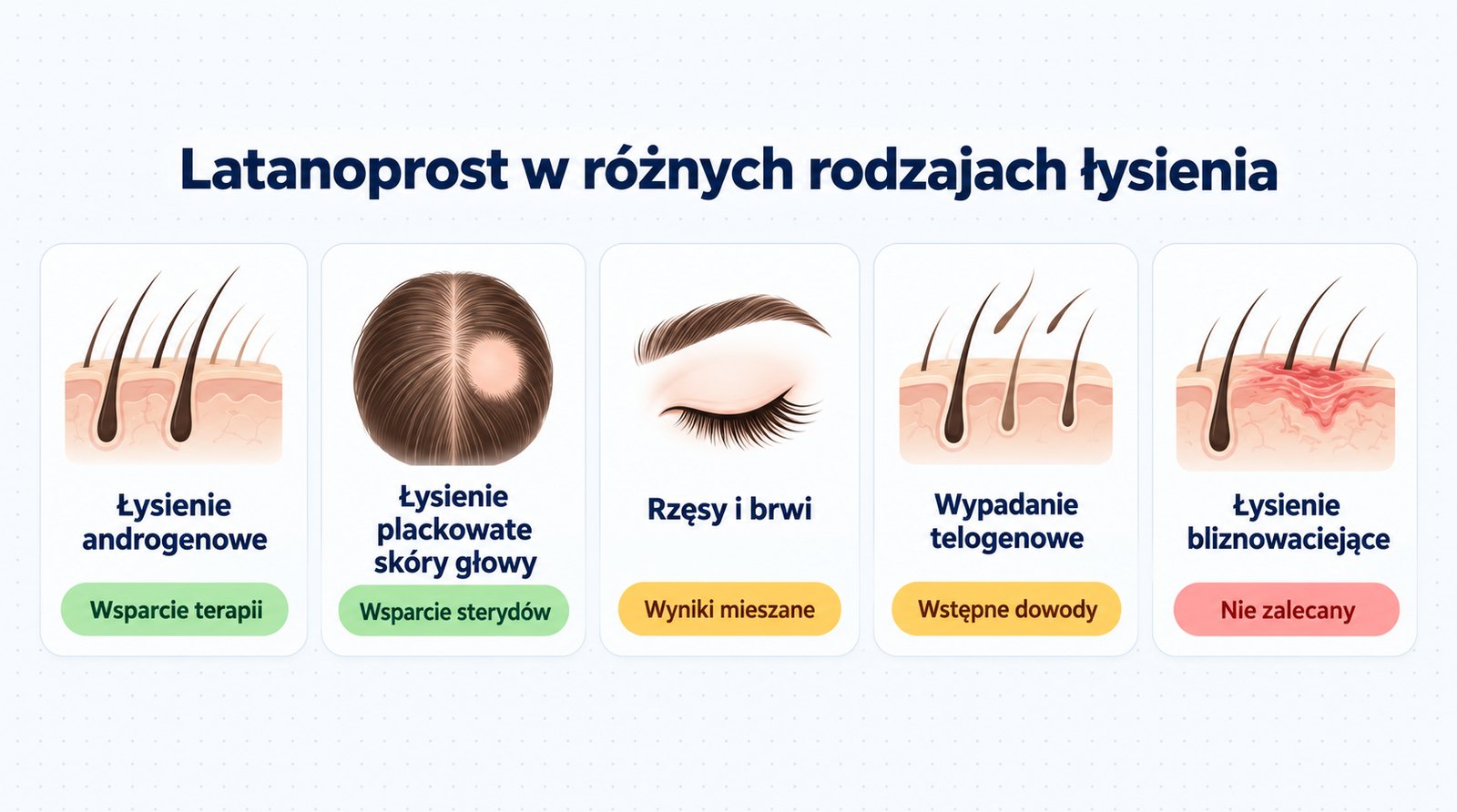 Latanoprost w różnych rodzajach łysienia: wsparcie w łysieniu androgenowym i plackowatym, wyniki mieszane w rzęsach i brwiach, brak zastosowania w łysieniu bliznowaciejącym