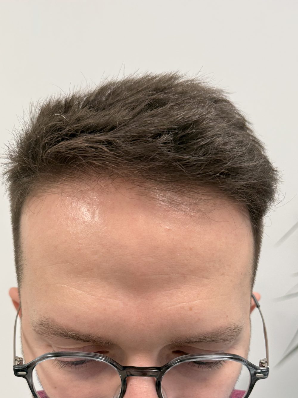 Po przeszczepie włosów FUE — linia czołowa, Perfect Hair Clinic