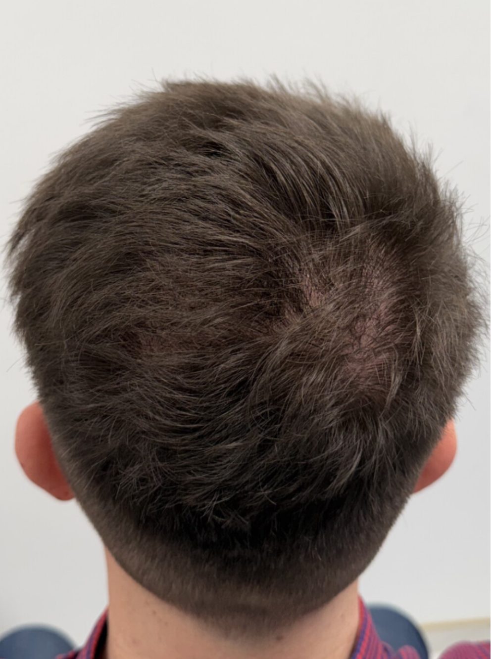 Po przeszczepie włosów FUE — wierzchołek głowy, Perfect Hair Clinic
