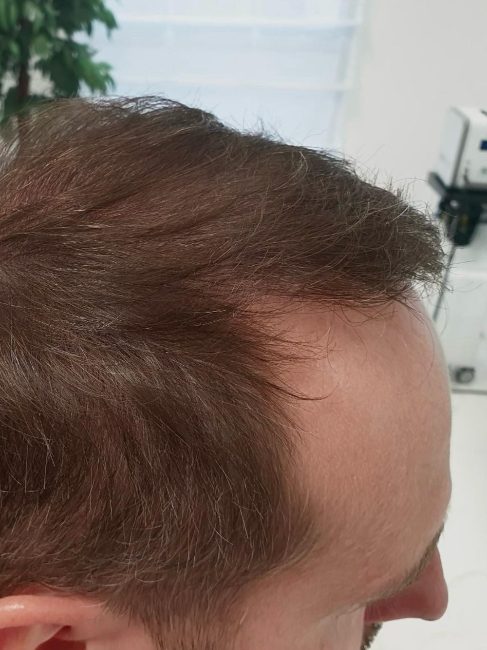 Po przeszczepie włosów FUE — skronie i zakola, Perfect Hair Clinic