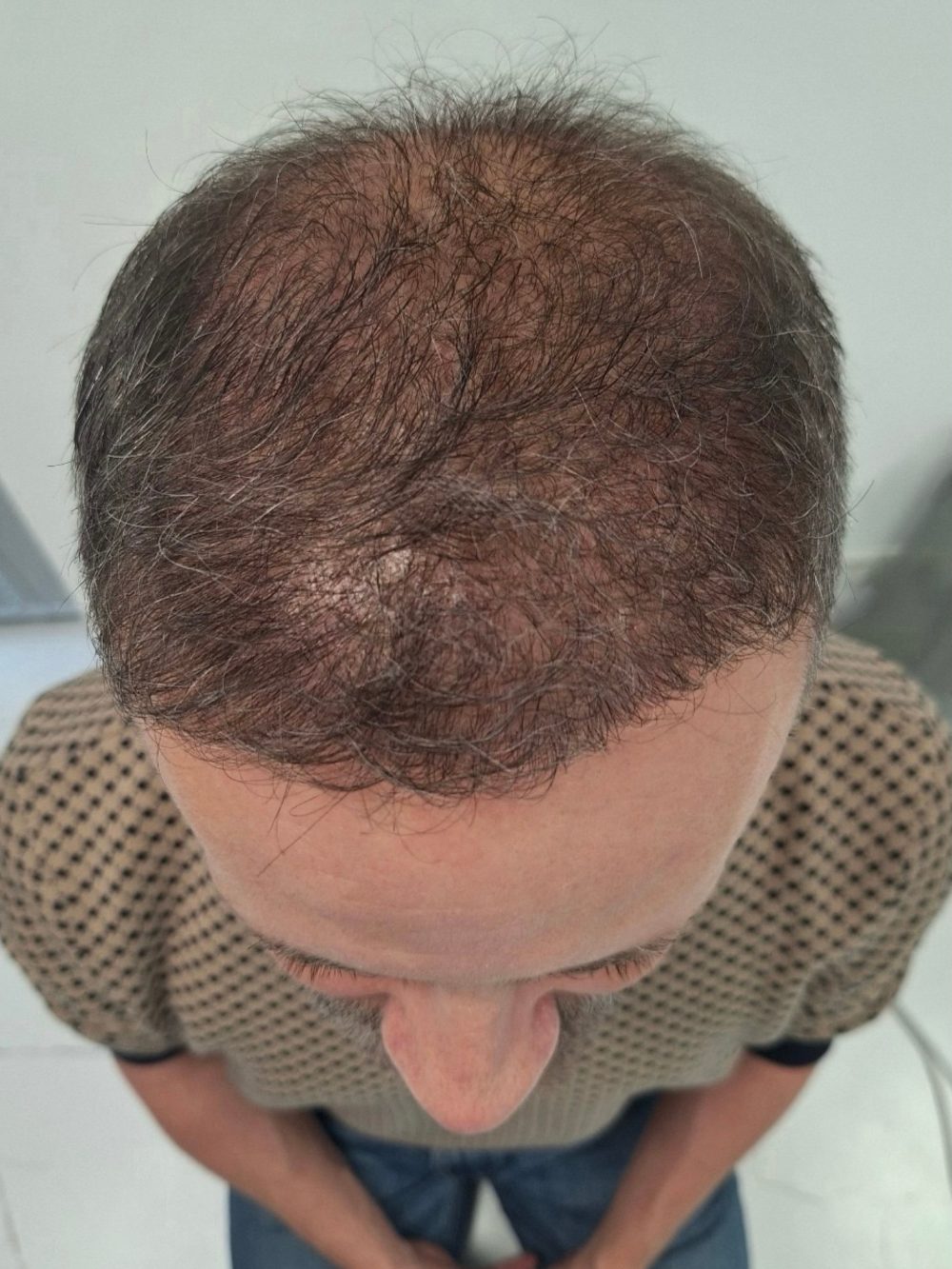 Po przeszczepie włosów FUE — wierzchołek głowy, Perfect Hair Clinic