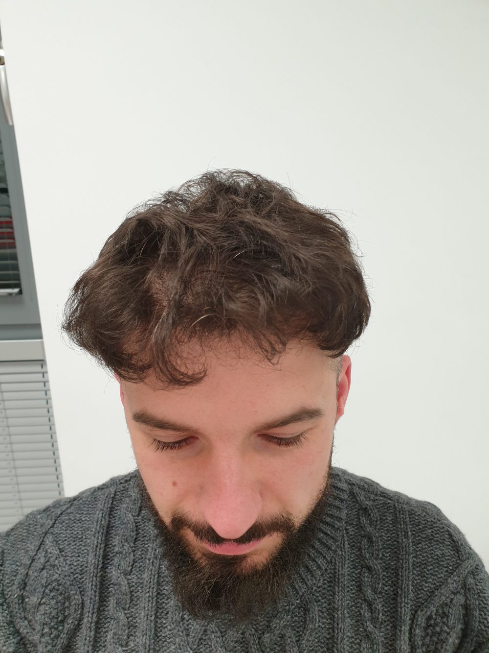 Po przeszczepie włosów FUE — linia czołowa, Perfect Hair Clinic