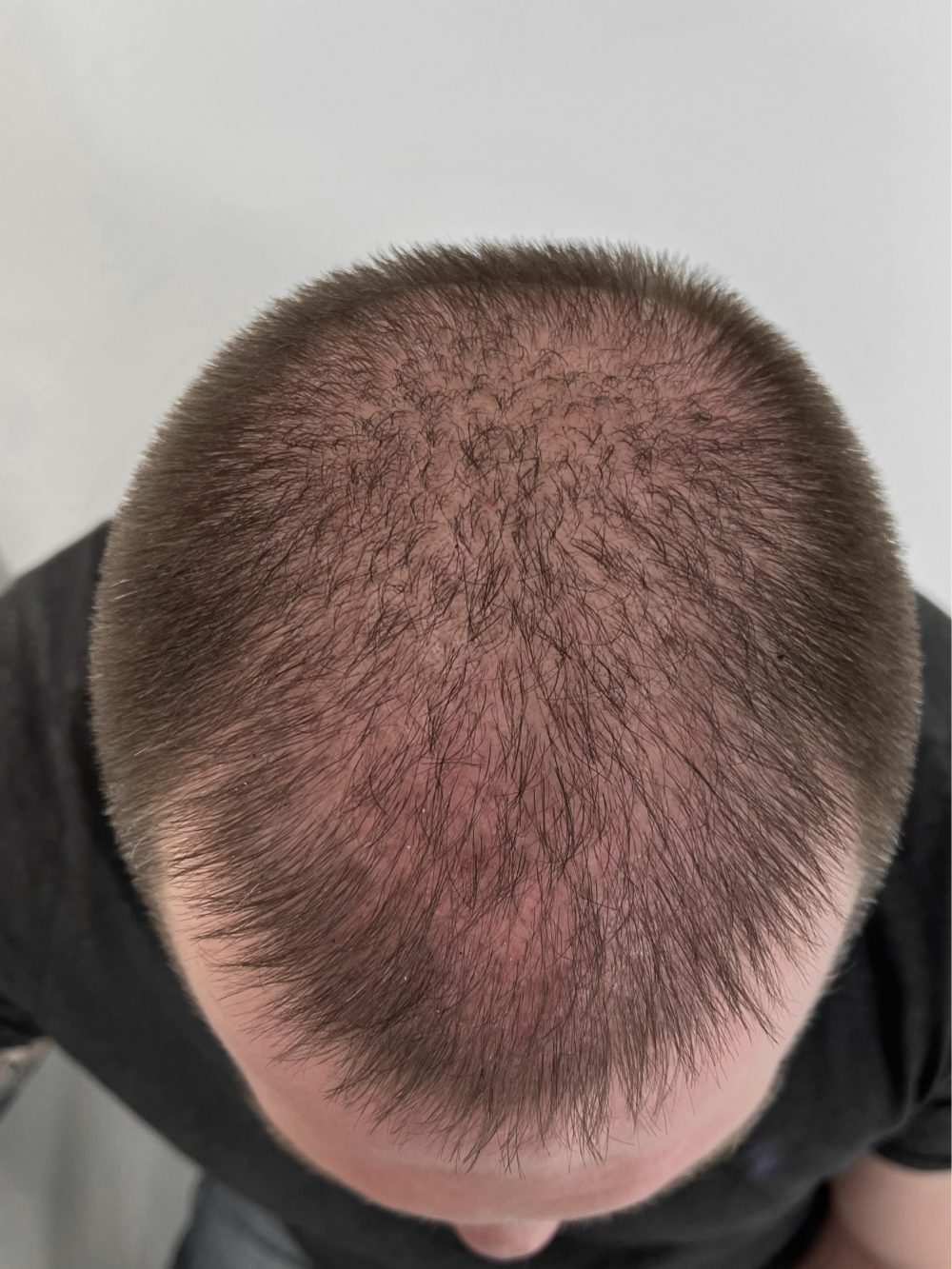 Po przeszczepie włosów FUE — wierzchołek głowy, Perfect Hair Clinic