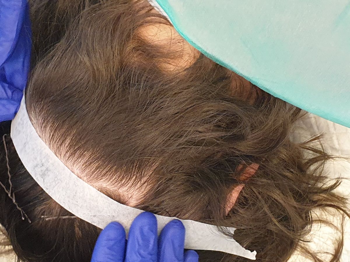 Zabieg terapii komórkami macierzystymi skóry głowy w Perfect Hair Clinic